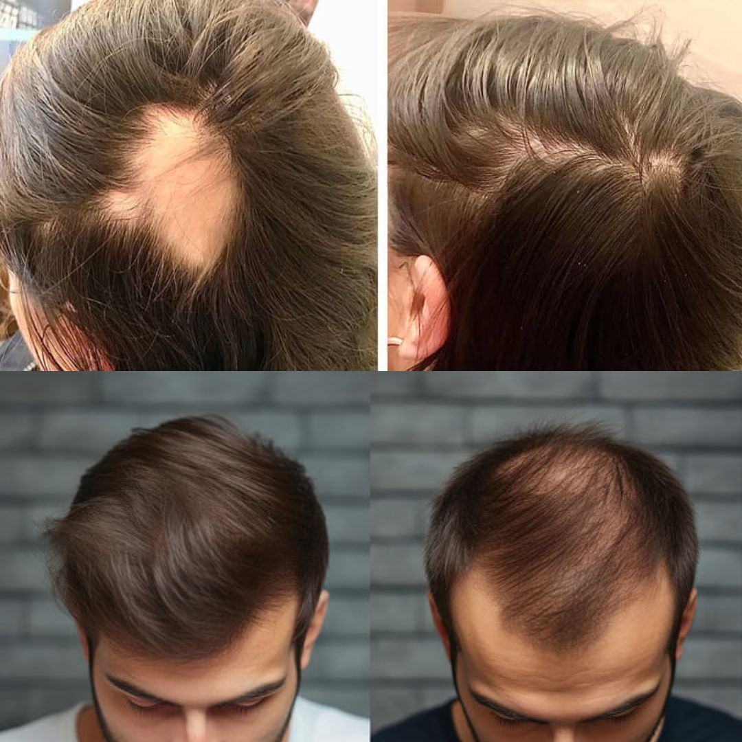 Risultato Esocrease Hair — uomo 35 anni