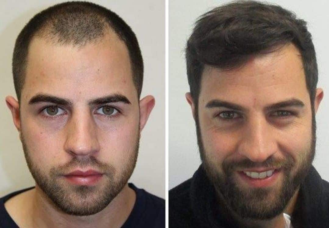 Before after Esocrease — uomo 38 anni