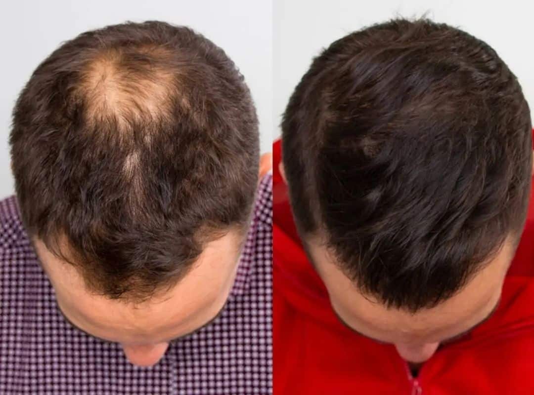 Before after Esocrease — uomo 40 anni