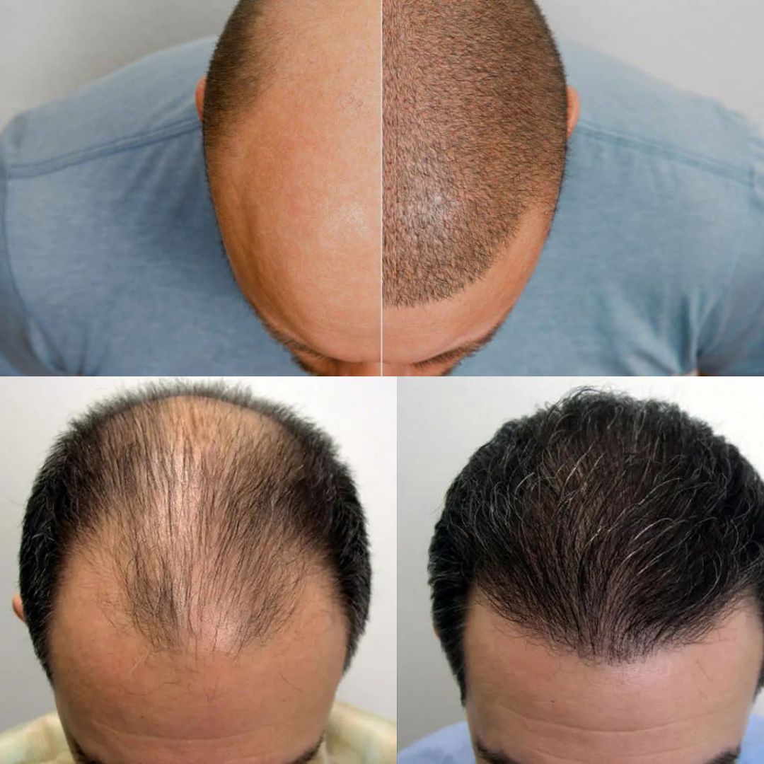 Before after Esocrease — uomo 30 anni
