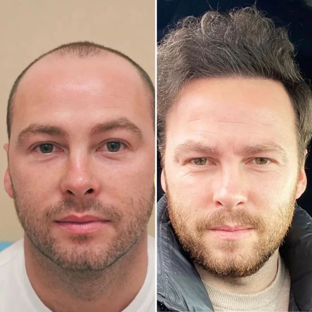 Before after Esocrease — uomo 43 anni