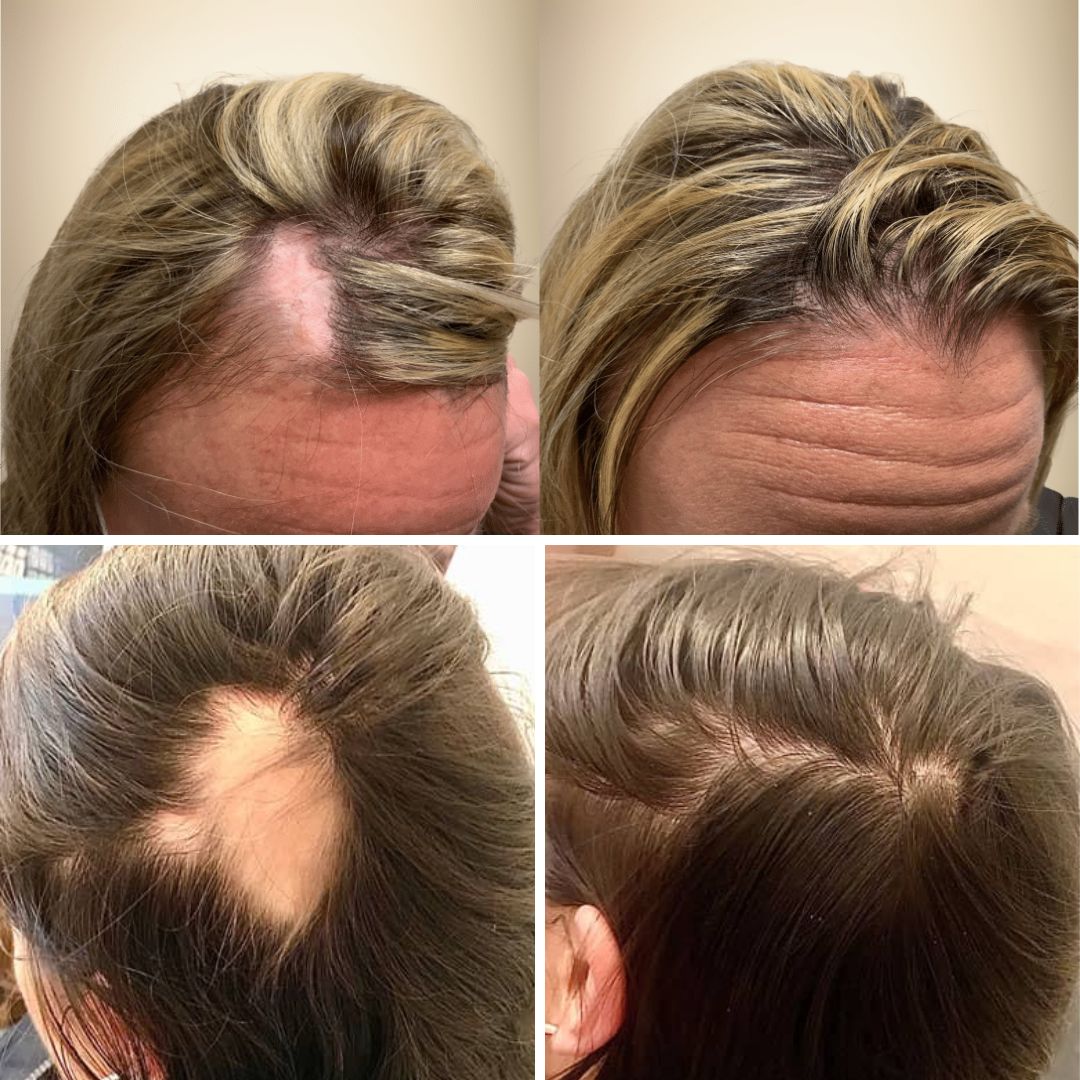 Risultato Esocrease Hair — donna 48 anni