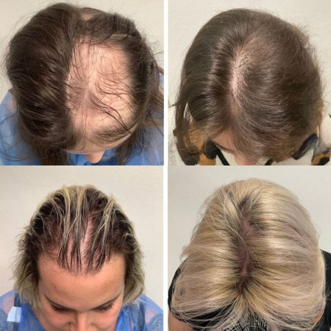 Risultato Esocrease Hair — donna 42 anni