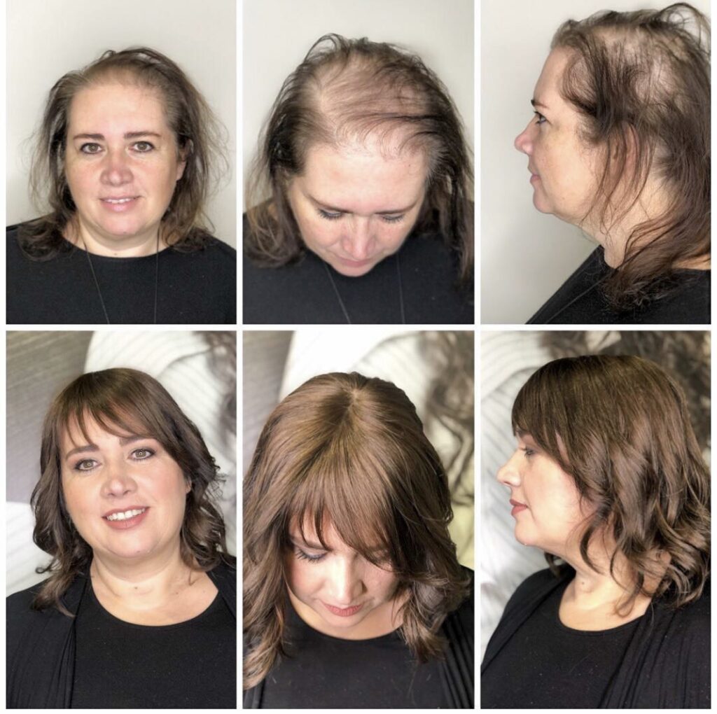 Before after Esocrease — donna 45 anni