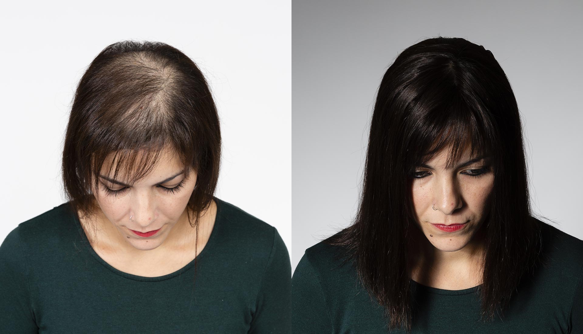 Before after Esocrease — Anna, donna 50 anni