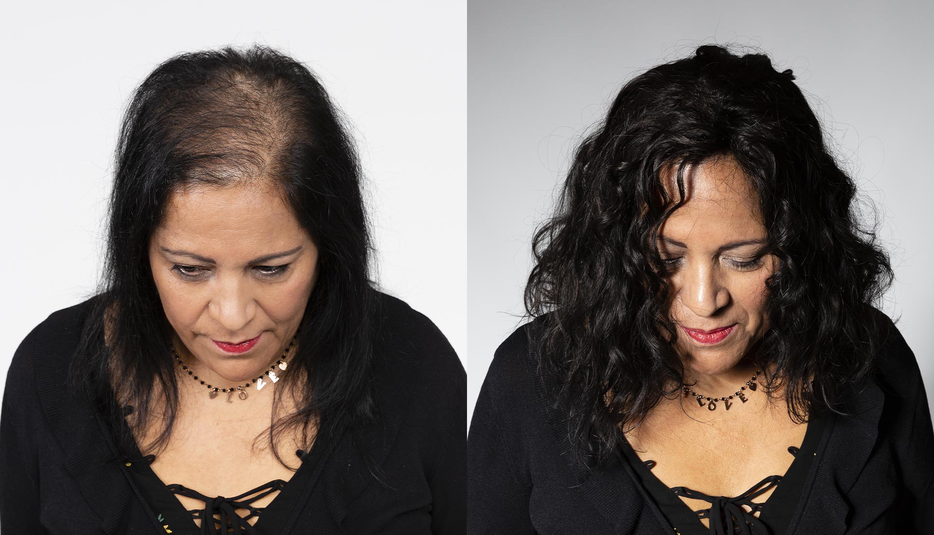 Before after Esocrease — Laura, donna 43 anni